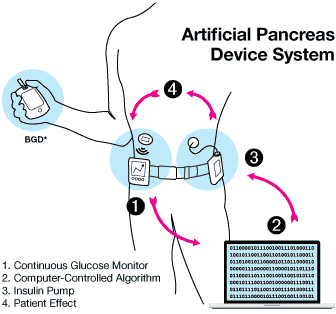 Biyoteknolojik ürün: yapay pankreas