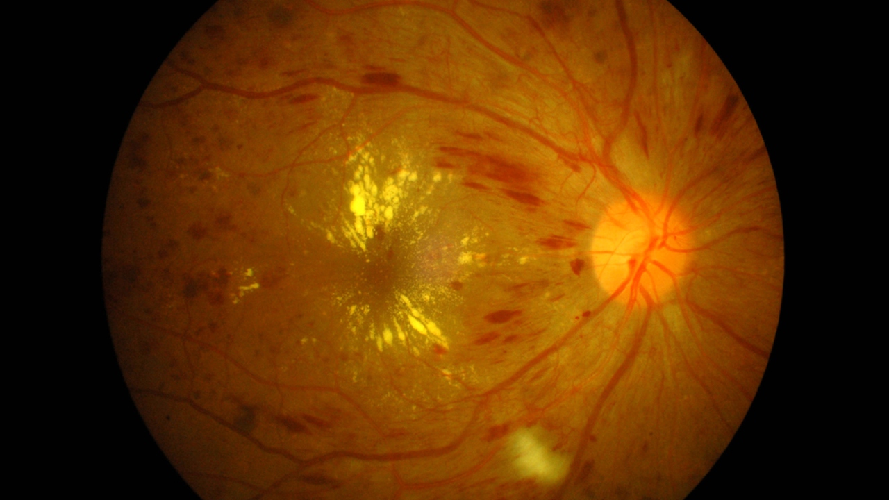 Diyabet ve diyabetik retinopati